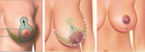 cost breast lift tunisia